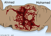 Сосуды головного мозга Ахмеда и Мохаммеда. Фото АР с сайта ВВС