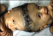 Сиамские близнецы. Фото АР.